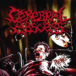 Cerebral Abscess : Promo
